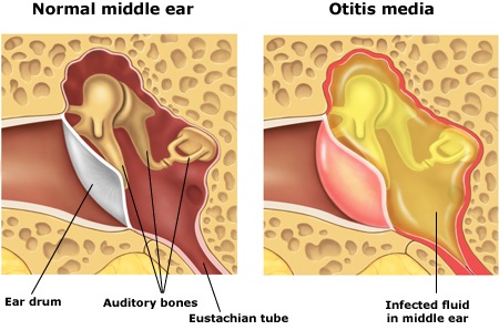 Middle Ear Infection