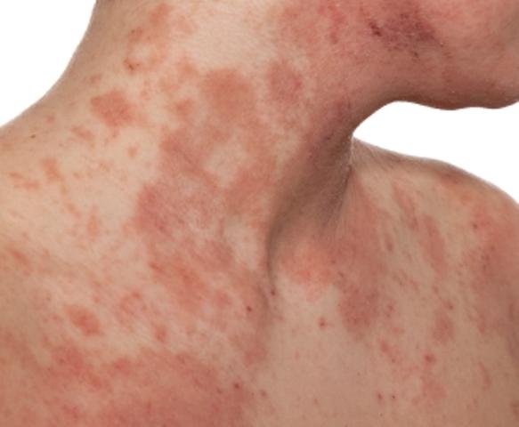 tea tree oil eczema